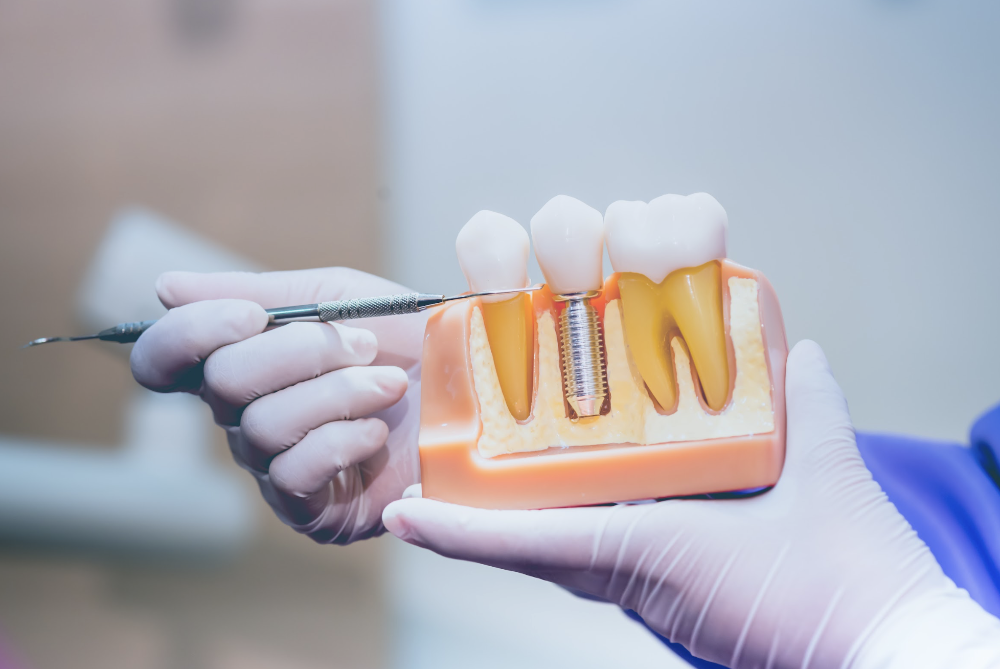 dental implants illustration