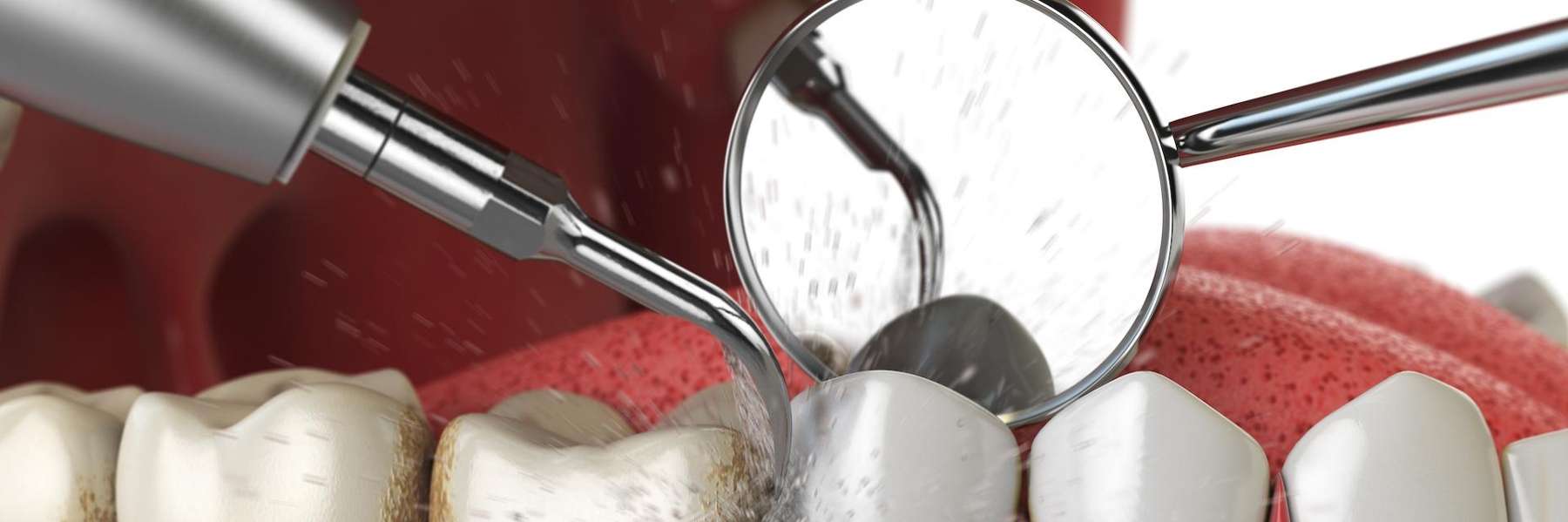 dental cleaning in anderson sc