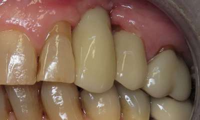 Dental-Implant-and-a-Traditional-Crown-After-Image