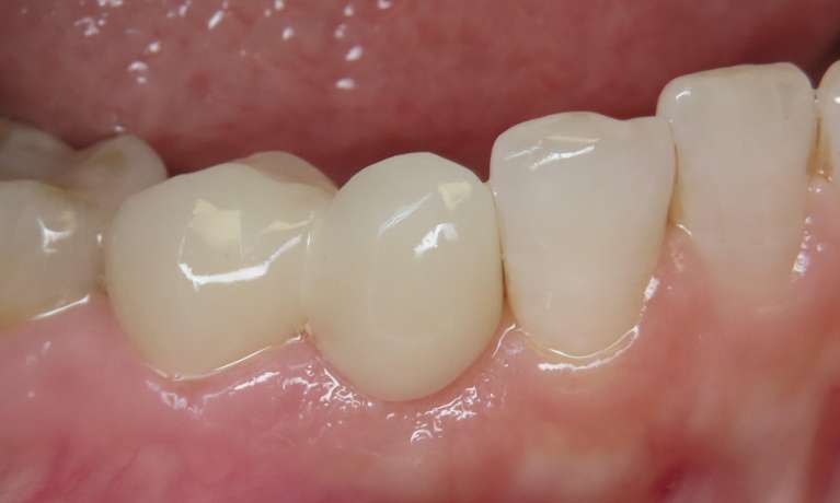 After Cantilever Bridge