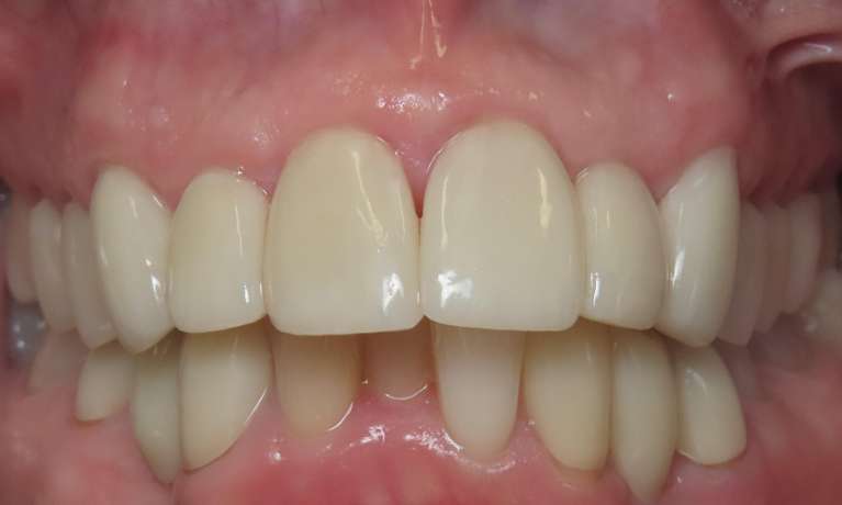 Veneers-for-Upper-Front-Teeth-After-Image