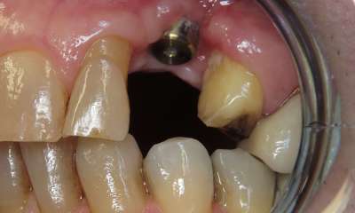 Dental-Implant-and-a-Traditional-Crown-Before-Image