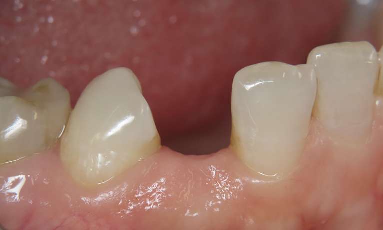 Before Cantilever Bridge