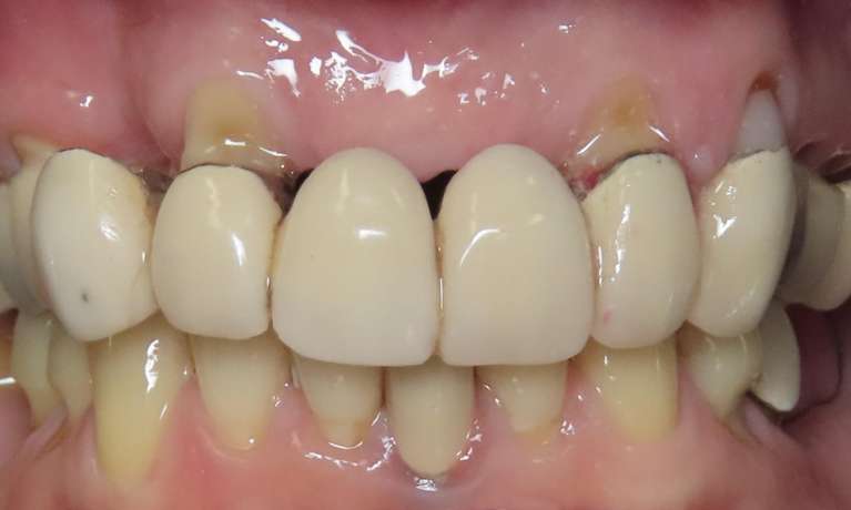 Replacement-of-Old-Failing-Front-Teeth-Bridge-Before-Image