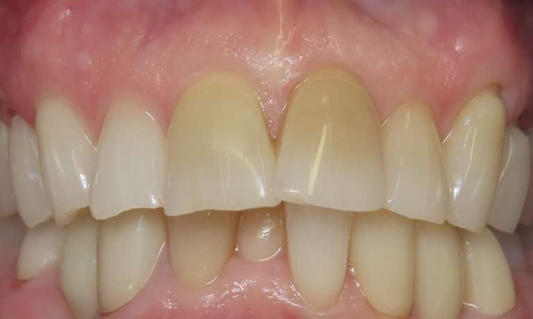 Veneers-for-Upper-Front-Teeth-Before-Image